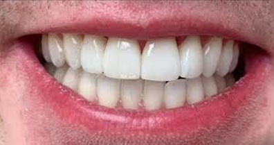 Dentnet Fast protetik - efter