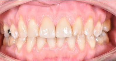 Dentnet Fast protetik - före