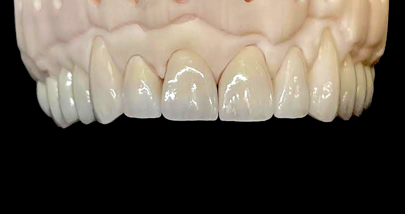 Dentnet - kronor i ök